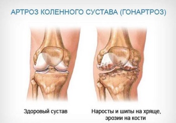 IMG: А вот и артроз!